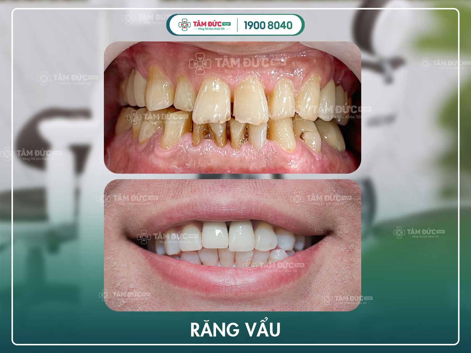 hình ảnh răng vẩu