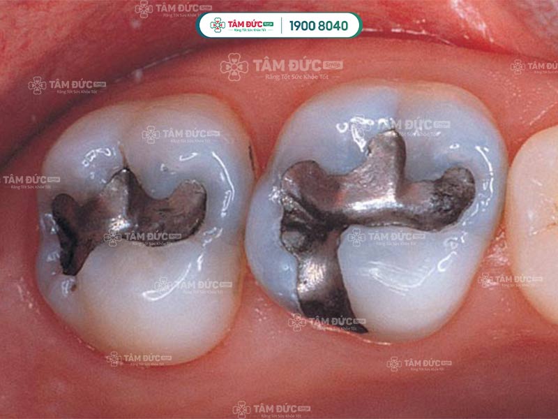 răng trám có tẩy trắng được hay không