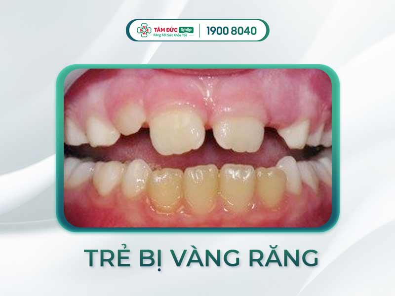 RĂNG TRẺ BỊ VÀNG LÀM SAO ĐỂ HẾT? CÁCH BẢO VỆ RĂNG CHO BÉ TẠI NHÀ
