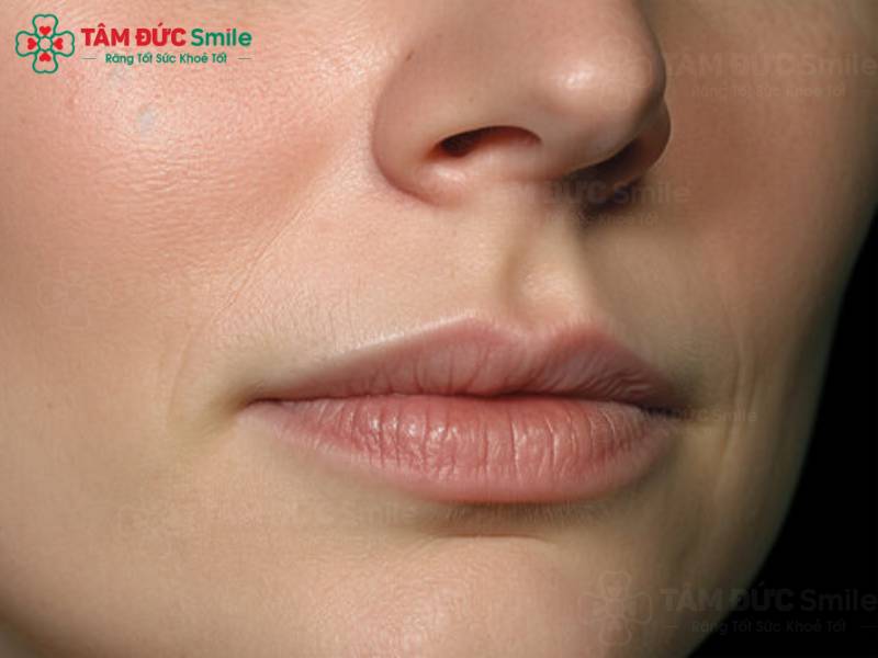 rãnh cười là gì