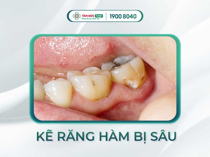SÂU KẼ RĂNG HÀM: CÁCH NHẬN BIẾT VÀ ĐIỀU TRỊ DỨT ĐIỂM