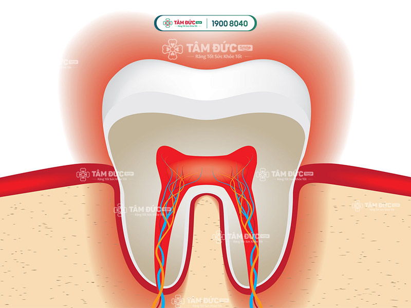 răng nhạy cảm do sâu kẽ răng hàm
