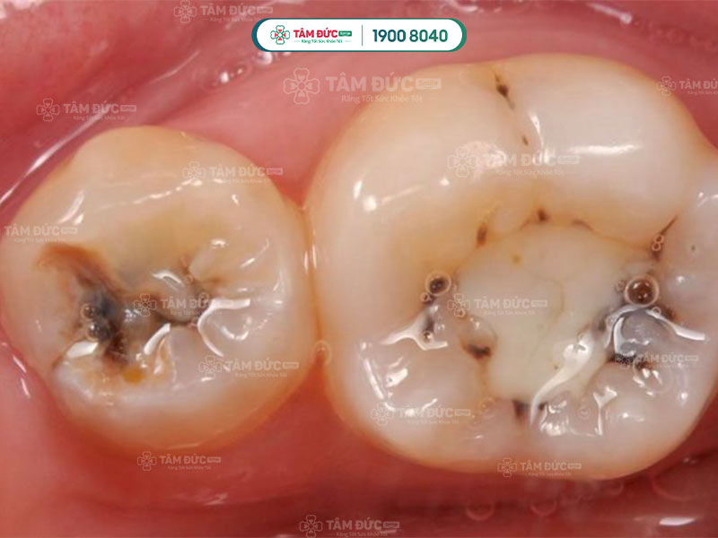 sưng nướu răng có phải dấu hiệu khi mang thai?