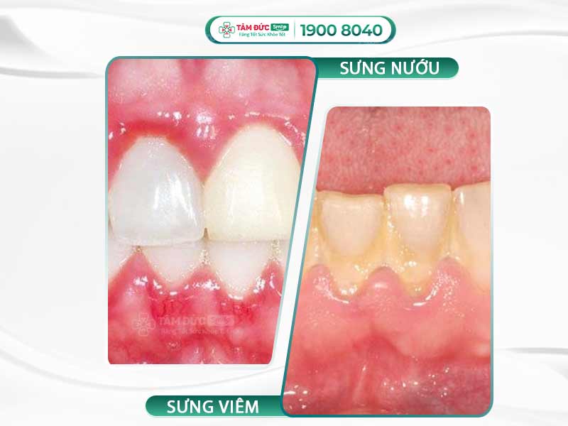 SƯNG NƯỚU RĂNG CÓ PHẢI DẤU HIỆU KHI MANG THAI? CÁCH KHẮC PHỤC AN TOÀN