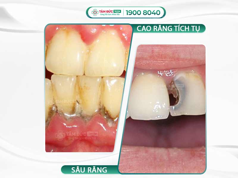 TẠI SAO BỊ VIÊM NƯỚU CHÂN RĂNG? TRỊ DỨT ĐIỂM VIÊM NƯỚU RĂNG BẰNG 5 CÁCH SAU