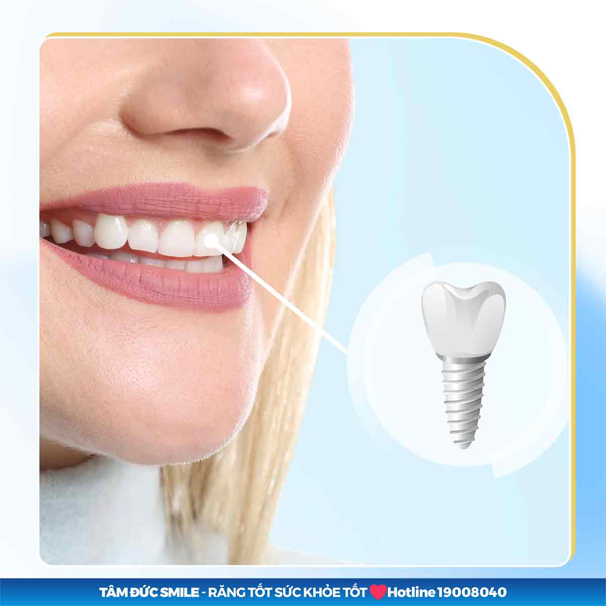 TẠI SAO MẤT RĂNG THÌ NÊN TRỒNG IMPLANT?