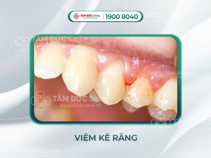 THẾ NÀO LÀ VIÊM KẼ RĂNG? CÁCH KHẮC PHỤC VIÊM KẼ CHÂN RĂNG HIỆU QUẢ