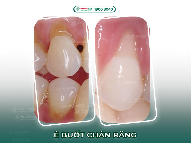 TRIỆU CHỨNG Ê BUỐT CHÂN RĂNG LÀ BỆNH GÌ?