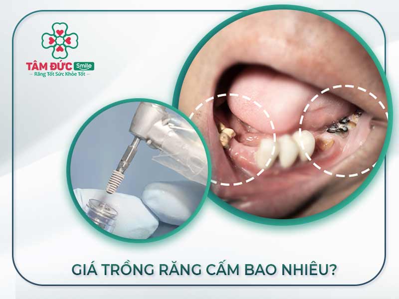 TRỒNG RĂNG CẤM GIÁ BAO NHIÊU? ĐỊA CHỈ TRỒNG RĂNG CẤM ĐÁNG TIN CẬY