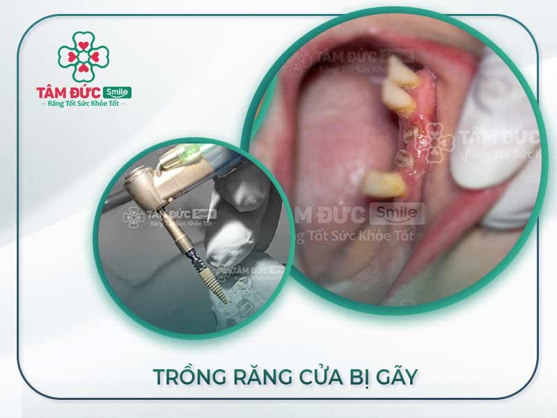 TRỒNG RĂNG CỬA BỊ GÃY CÓ ĐƯỢC KHÔNG? GIÁ TRỒNG RĂNG CỬA BAO NHIÊU TIỀN?