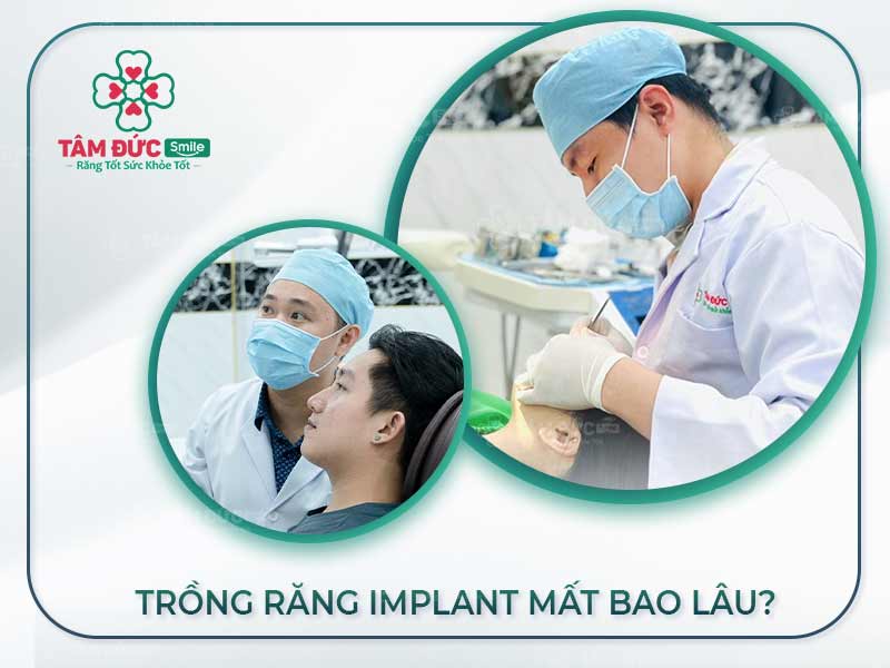 TRỒNG RĂNG IMPLANT MẤT BAO LÂU THÌ HOÀN THÀNH? CÁCH RÚT NGẮN THỜI GIAN TRỒNG RĂNG