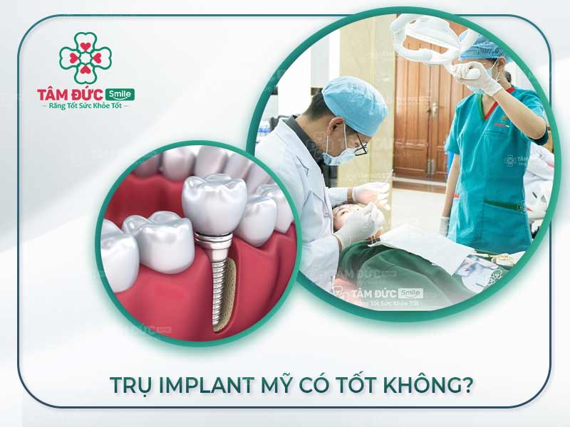 TRỒNG RĂNG TRỤ IMPLANT MỸ CÓ TỐT KHÔNG? 3 DÒNG TRỤ IMPLANT MỸ TỐT NHẤT