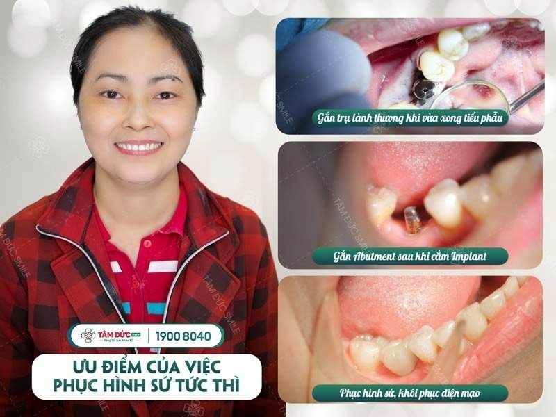 trụ implant nobel active