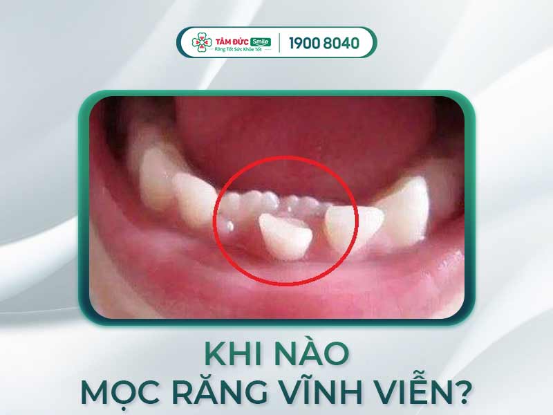 TUỔI MỌC RĂNG VĨNH VIỄN Ở TRẺ LÀ BAO NHIÊU?