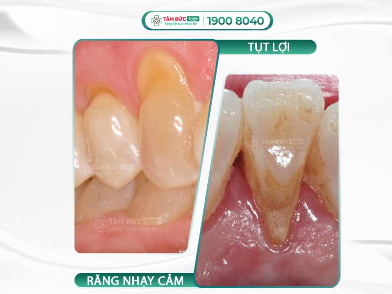 TỤT LỢI CHÂN RĂNG LÀ GÌ? VÌ SAO TỤT LỢI CHÂN RĂNG NGUY HIỂM?