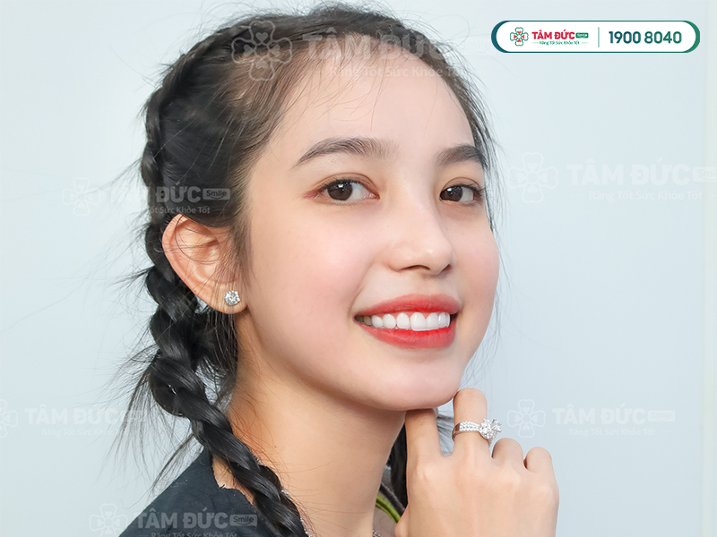 Ưu Và Nhược Điểm Về Các Loại Răng Sứ Phổ Biến Hiện Nay