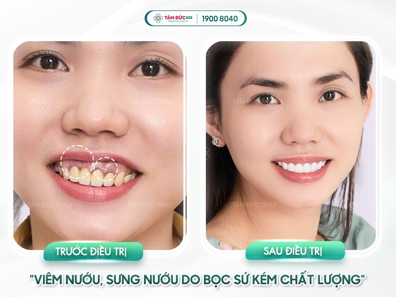 Vì sao răng bị đen viền nướu sau khi bọc răng sứ?