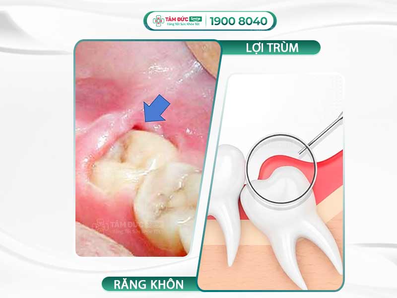 VIÊM LỢI TRÙM: DẤU HIỆU CẢNH BÁO SỚM VÀ GIẢI PHÁP ĐIỀU TRỊ TRIỆT ĐỂ, AN TOÀN