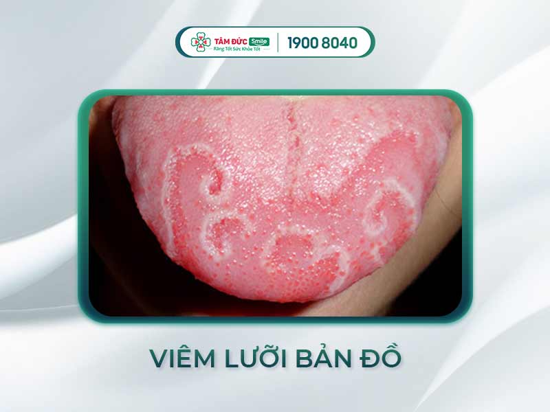 VIÊM LƯỠI BẢN ĐỒ Ở NGƯỜI LỚN: BIỂU HIỆN, ẢNH HƯỞNG VÀ CÁCH CHỮA AN TOÀN