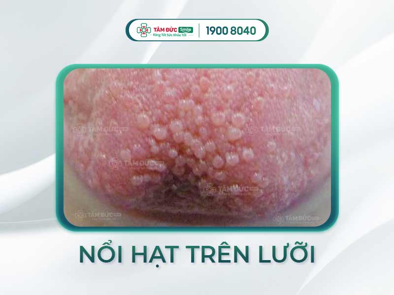 VIÊM LƯỠI NỔI HẠT LÀ BỆNH GÌ? NGUYÊN NHÂN VÀ CÁCH ĐIỀU TRỊ