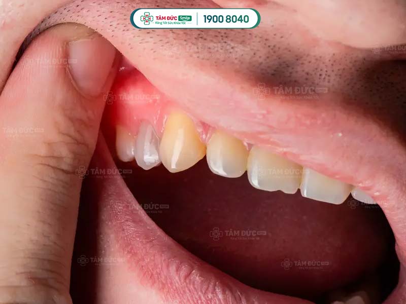 viêm mô tế bào răng