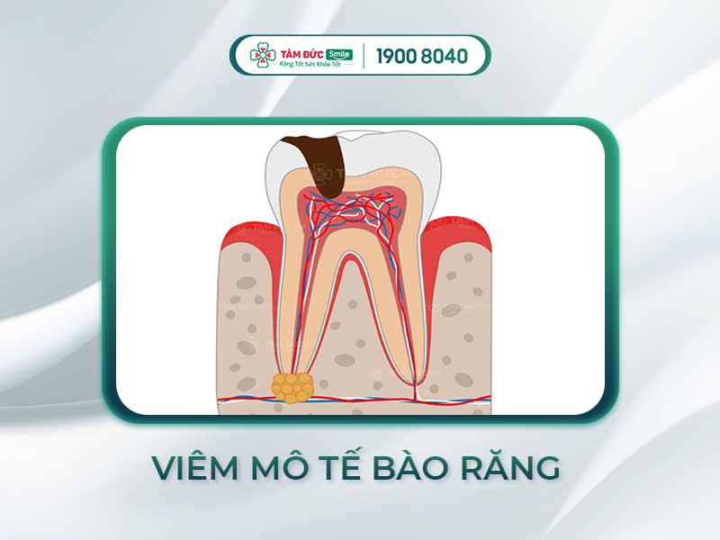 VIÊM MÔ TẾ BÀO RĂNG: NGUYÊN NHÂN, TRIỆU CHỨNG VÀ CÁCH ĐIỀU TRỊ