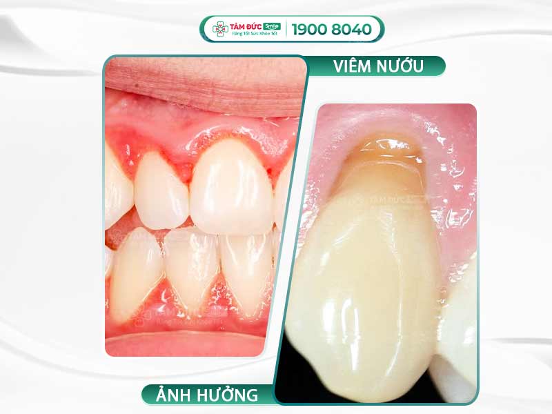 VIÊM NƯỚU LÀ GÌ? TÌM HIỂU VỀ NGUYÊN NHÂN, HẬU QUẢ VÀ CÁCH ĐIỀU TRỊ VIÊM NƯỚU
