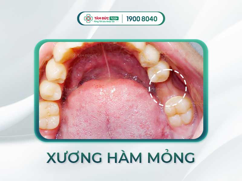 XƯƠNG HÀM MỎNG LÀ GÌ? CÓ THỂ NIỀNG VÀ TRỒNG RĂNG ĐƯỢC KHÔNG?
